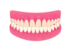 Underbite